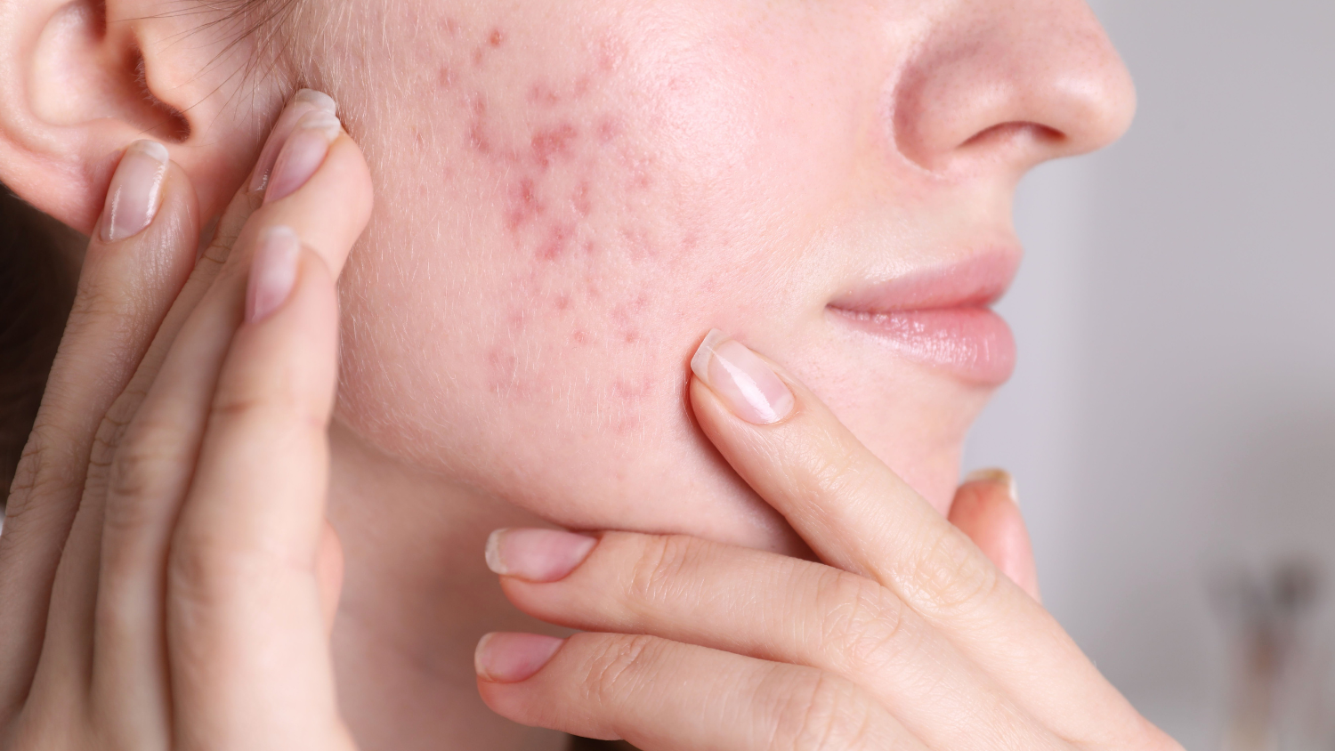 Close-up of a woman's acne-prone skin being examined, highlighting the use of Korean Skincare for Acne-Prone Skin: Clearer Skin with K-Beauty.