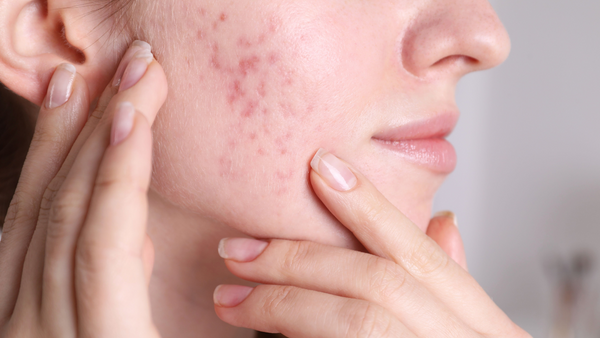 Close-up of a woman's acne-prone skin being examined, highlighting the use of Korean Skincare for Acne-Prone Skin: Clearer Skin with K-Beauty.
